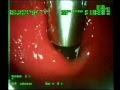 Srs endoskop ile refl operasyonu sonucu oluan valf yaps