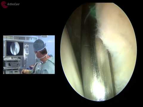 Hip Labral Repair Surgical Video