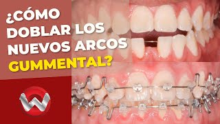 Cómo doblar los nuevos arcos Gummetal para un tratamiento exitoso de clase III