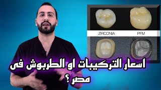 اسعار التركيبات او الطربوش فى مصر؟ #د_عبدالسلام_محمد #التجمع_الخامس #smile_expertez