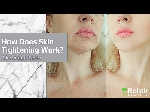 Thermage Skin Tightening Procedure