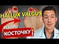Косточка на стопе | Hallux Valgus | Халлюкс Вальгус | Лечение и операции