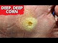 Deep seeded corn removal must watch