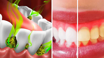 O que é bom para matar as bactérias da boca?