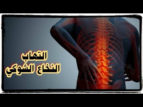 علاج التهاب النخاع الشوكي بالأعشاب الطبيعية