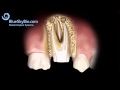 Patient Treatment Videos: Root Canal Re-treatment