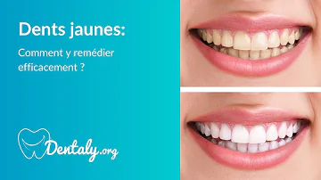 Comment faire blanchir des dents jaunes ?