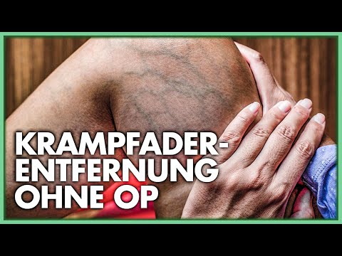 Krampfaderentfernung ohne Operation und ohne Narkose