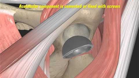 Anterior Hip Replacement Surgery