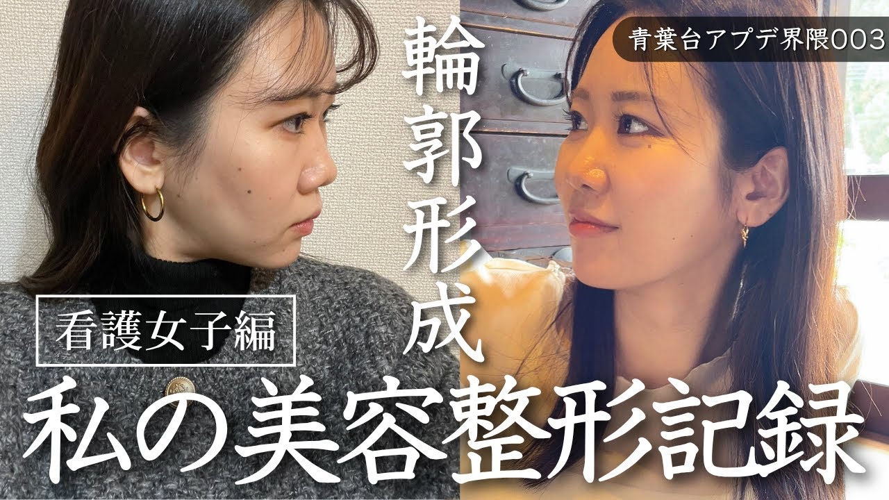 【ダウンタイム記録】輪郭形成のリアル｜腫れはいつ引く？内出血はどのくらい？実際の変化をお見せします！#糸リフト#脂肪吸引#脂肪注入