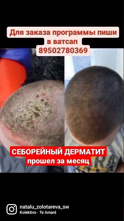 СЕБОРЕЙНЫЙ ДЕРМАТИТ прошёл за месяц - YouTube