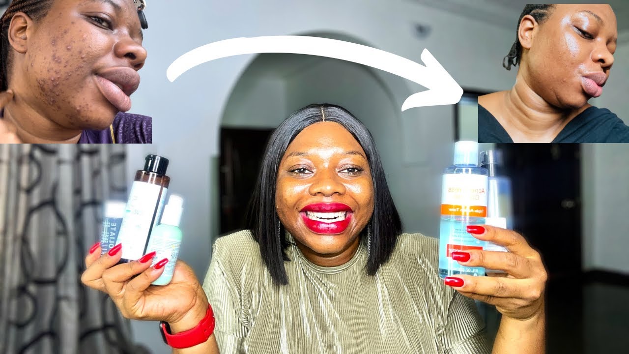 HOW I CLEARED MY ACNE + DARK SPOTS AFFORDABLE ACNE SKINCARE UPDATE ...