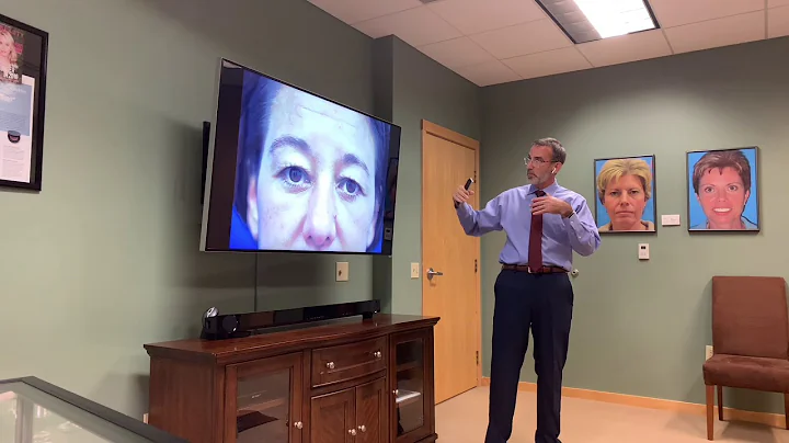 Robin's Upper Blepharoplasty Results -discussion w...