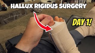 Hallux Rigidus Surgery What No One Tells You Day 1