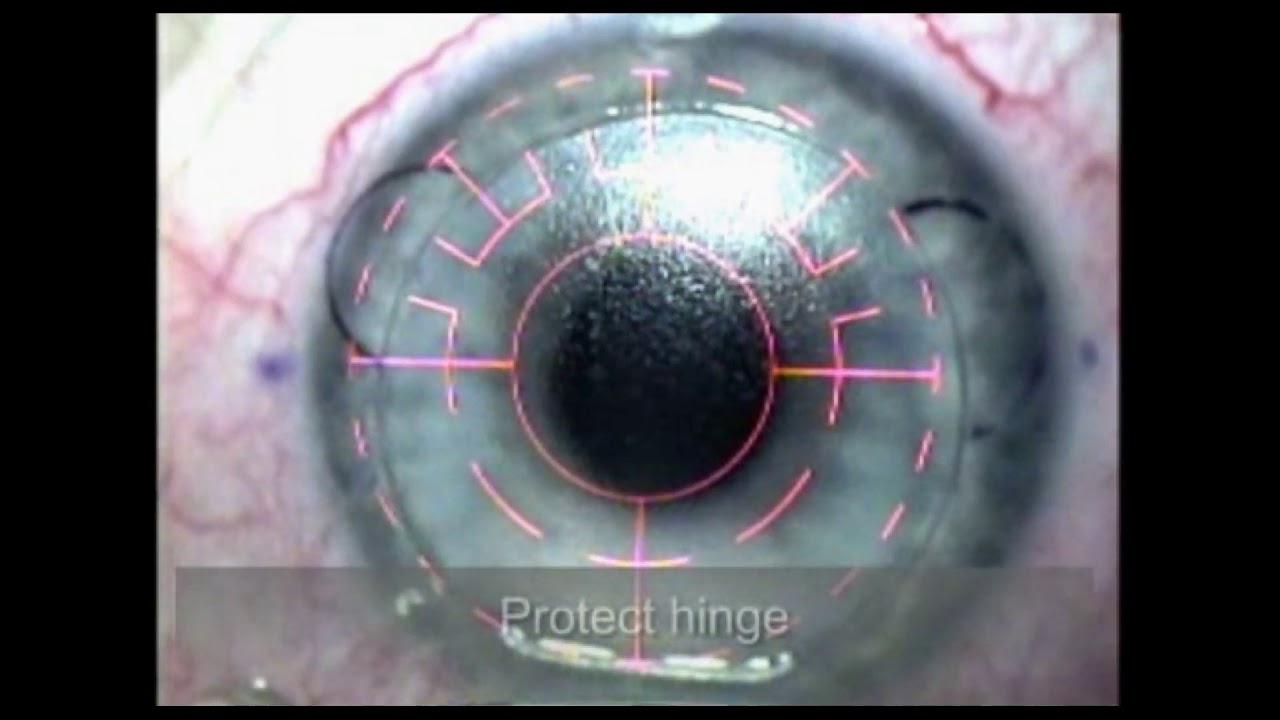 Routine Lasik With Intralase Youtube