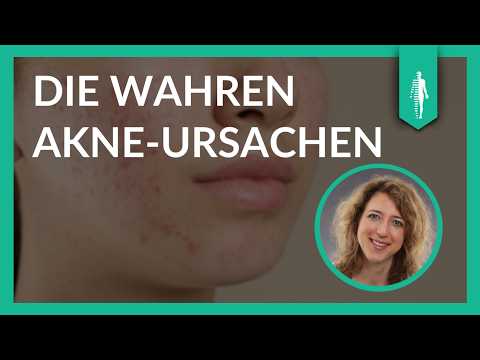 Copper, Viruses & Co.: What’s Really Behind Acne