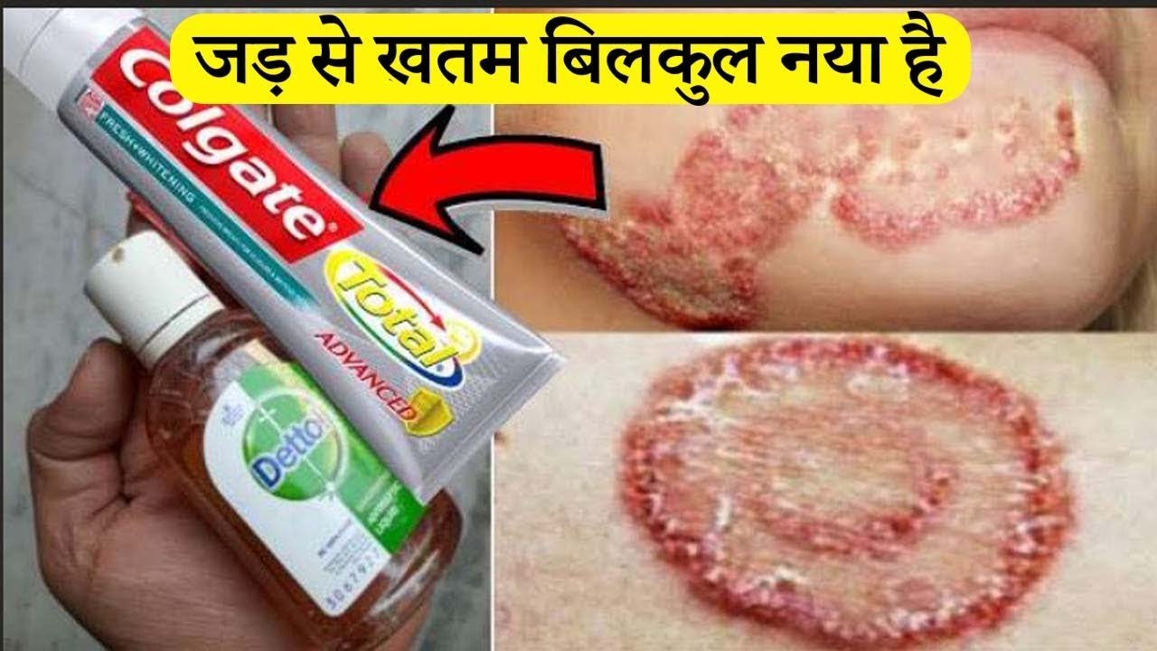 1 मिनट में दाद, खाज और खुजली हो जाएगा गायब, ये है नायाब नुस्खा Skin