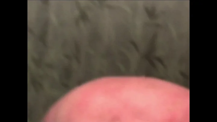 " Dr. " Ginger popper pimple cyst popping explosion
