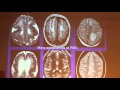 Prenatal MRI In The Diagnosis Of Malformations Of Cortical Development - Liat BEN SIRA Part 3