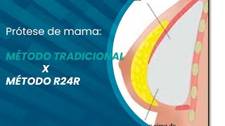 5 diferenças entre a prótese de mama tradicional e a R24R 5 diferenças entre a prótese de mama tradicional e a R24R