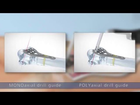 Video Hệ thống nẹp vít khoá đầu dưới xương quay trong điều... - youtube