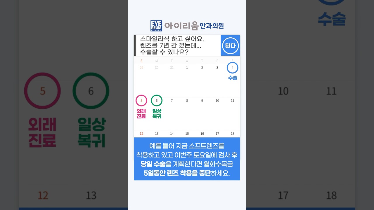 [艾利優眼科診所] 微笑雷射、微笑雷射Pro 手術過程及日程概要