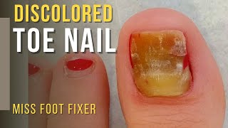 Discolored Nail Cleaning and Cutting *** Discolored Nail*** Full Treatment By Miss Foot Fixer