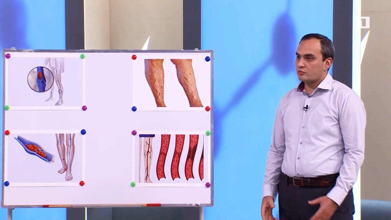 ԹՐՈՄԲԻ ԱՌԱՋԱՑՄԱՆ ՊԱՏՃԱՌՆԵՐԸ, ԲՈՒԺՈՒՄՆ ՈՒ ԿԱՆԽԱՐԳԵԼՈՒՄԸ