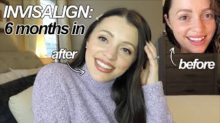 THE TRUTH ABOUT INVISALIGN / Before + After 6 months + FAQ Answered