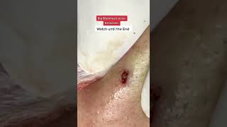 34 Bigblackheadstoneextraction