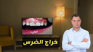 علاج خراج الضرس في البيت و في العيادة