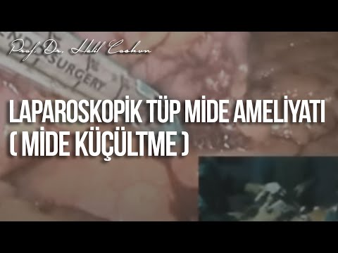 Laparoskopik Tüp Mide Ameliyatı (Mide Küçültme) / Prof. Dr. Halil Coşkun