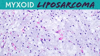 Myxoid Liposarcoma (explained in 5 minutes) basic soft tissue pathology sarcoma pathologists screenshot 3