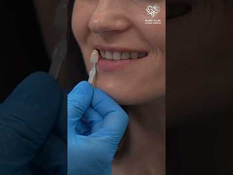 قشور الفينير اختيار درجة اللون المناسب لأسنان مريضتنا