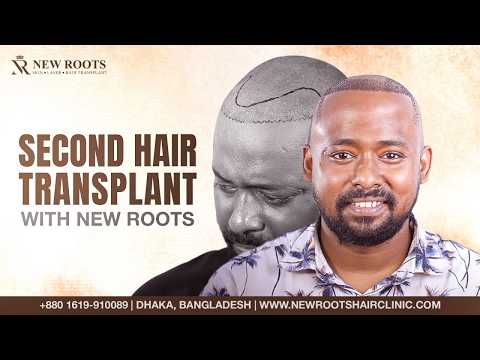 Hope for Better Hair Restoration This Time! 🙏 | Corrective Hair Transplant | Bangladesh | New Roots
