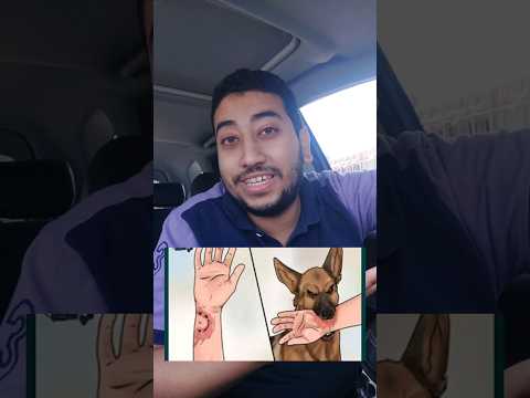 داء الكلب وحقيقة ٢١ حقنة في البطن
