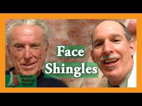 Face Shigles Behandling | Auburn Medical Group