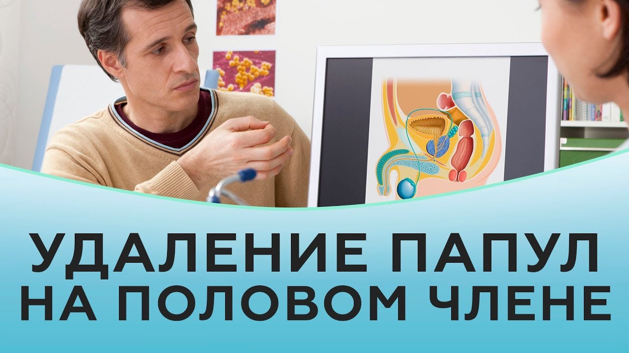 Удаление перламутровых папул на половом члене - YouTube