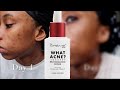 The Creme Shop What Acne? Vitamin C Serum Review: Personal Skincare Journey and Insights