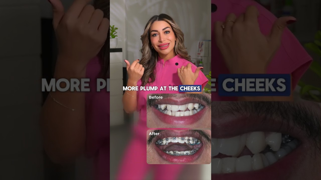 Can braces really transform your face??? #Storytime