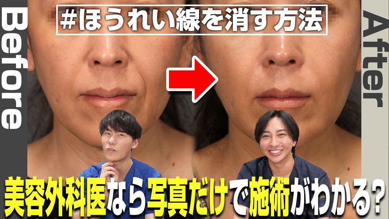 金澤のりおみ先生の症例写真が凄すぎる！美容外科医が答えるほうれい線治療クイズ！