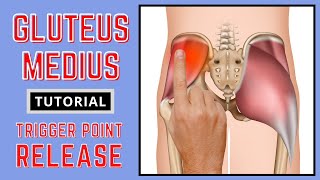 Trigger Point Release  Gluteus Medius