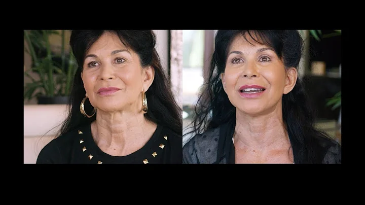 Facial Rejuvenation | Cassie's Story | TV | Dr. Zewert M.D., PH.D.