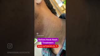 Neck rash |Atopic Dermatitis | Childhood Eczema #drashimagoel #dermatologistinchandigarh #shorts