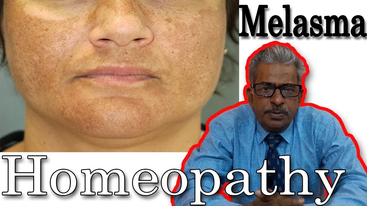 Melasma (chloasma) Remedy in Homeopathy by Dr. P.S. Tiwari