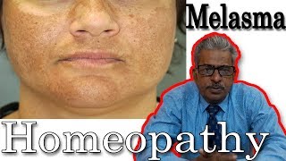 Melasma (chloasma) Remedy in Homeopathy by Dr. P.S. Tiwari screenshot 5