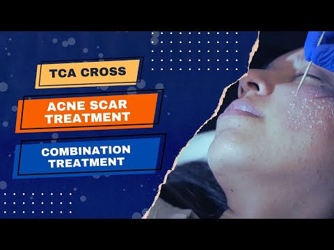 TCA Cross | Acne Scar Treatment | Jason Emer MD | Combination Treatment