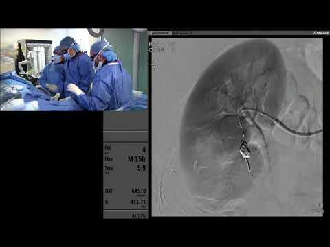 Transradial Coil and Plug Embolization of a Renal Arterial Venous Fistula