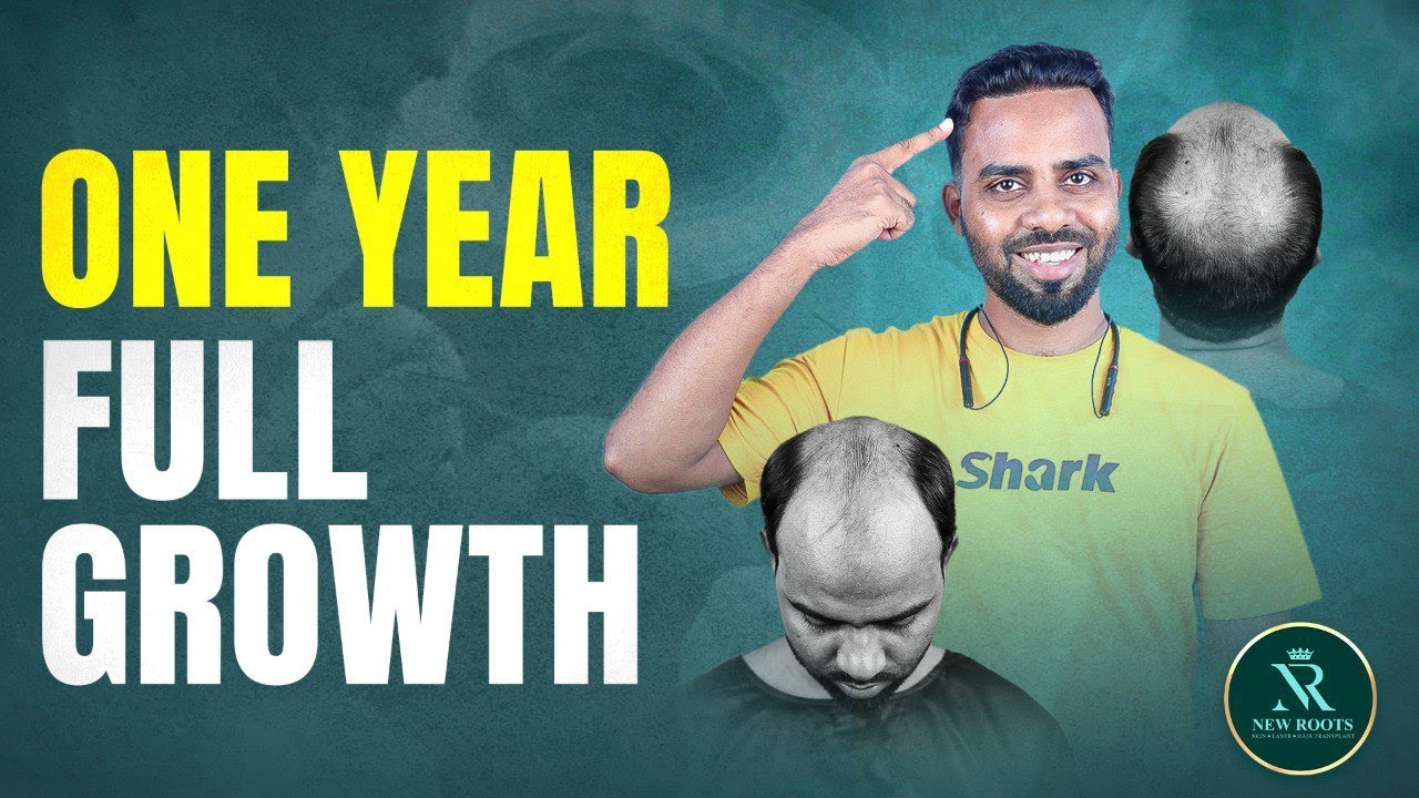 Grade 6 Baldness GONE! | Bio Sapphire Hair Transplant (5800 Grafts) | Bangladesh | New Roots