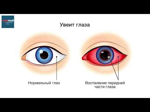 УВЕИТ ГЛАЗА. Острый Иридоциклит, ирит и хориоидит. Симптомы и лечение увеита